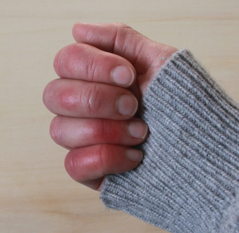 Beyond Frostbite: Why Indiana’s damp cold could trigger painful chilblains