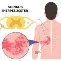 CDC urges shingle vaccination: Historic high protection rates for older adults and the immunocompromised